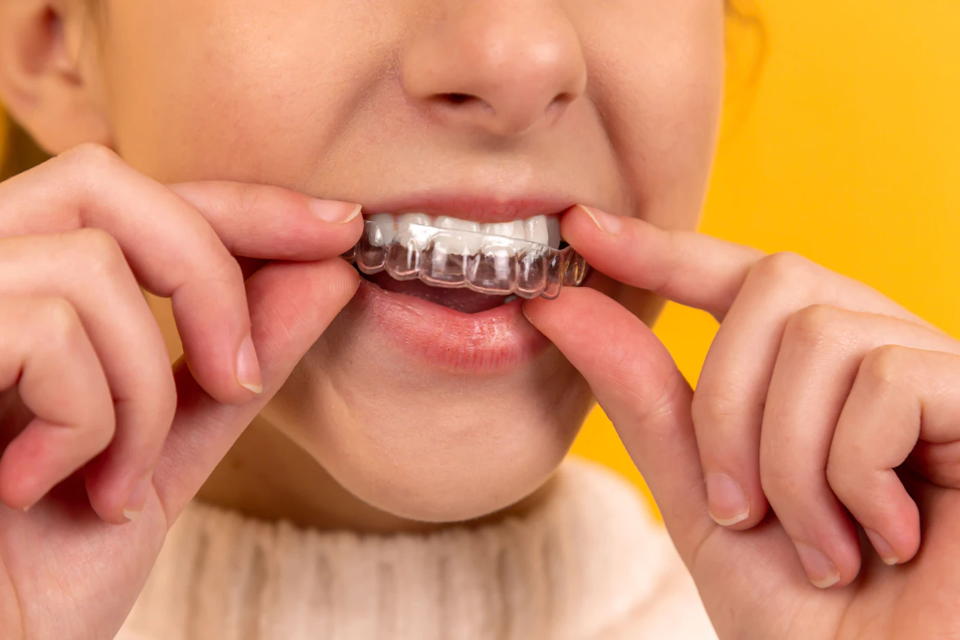 Placeholder photograph of a clear dental aligner